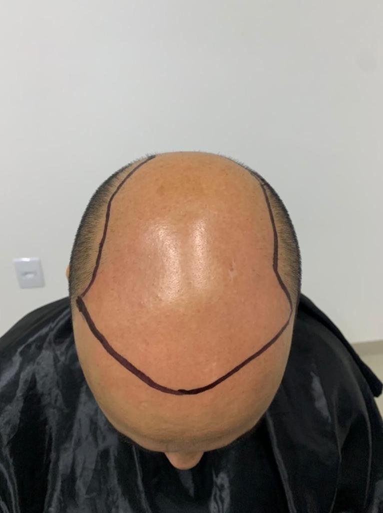 Antes do transplante capilar